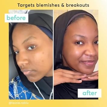 Super Facialist On The Spot Clarifying Gel - Spot Treatment for Acne with 10% Niacinamide, Tea Tree Oil & Prebiotics, Vegan Friendly 15ml : Amazon.co.uk: Beauty