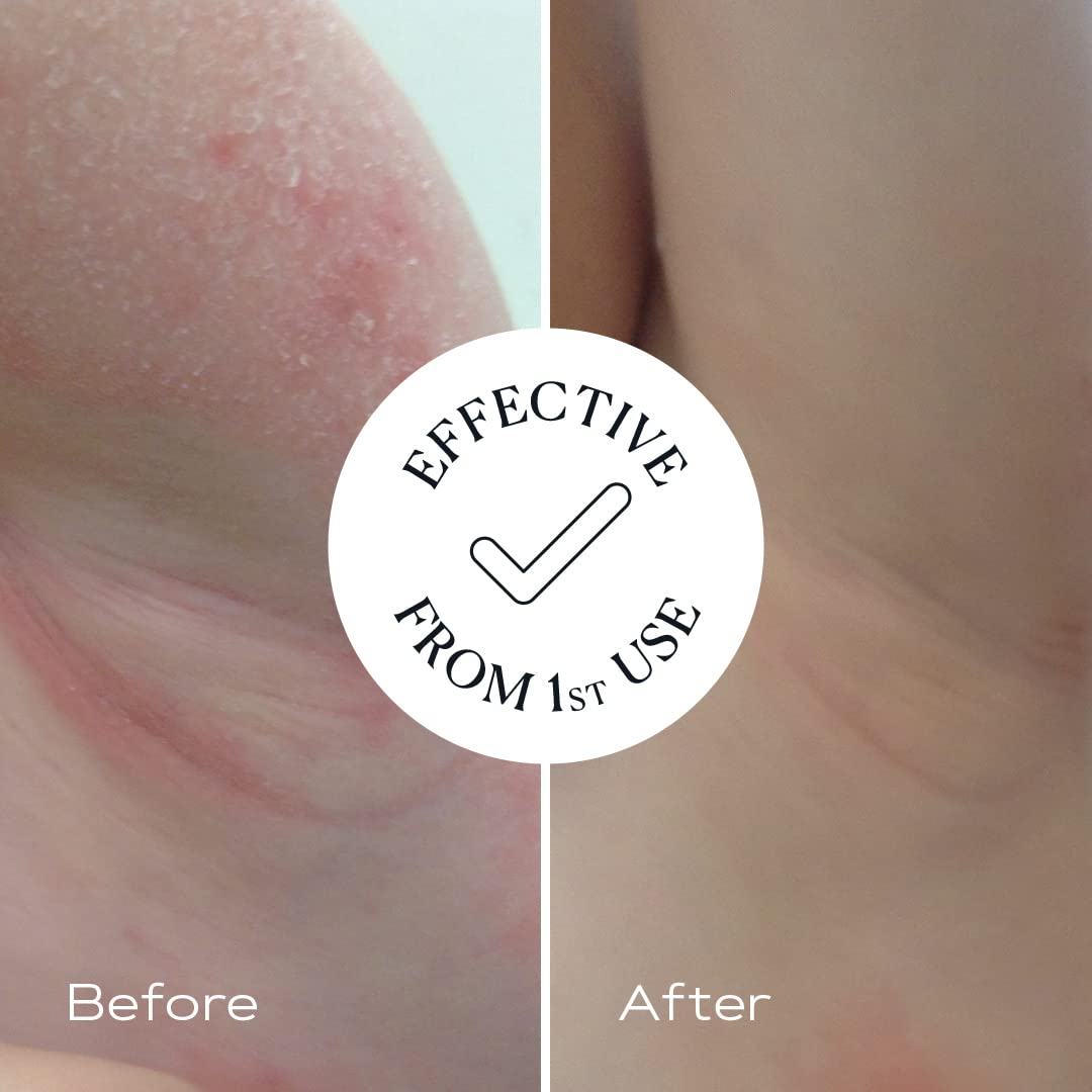 KAMEDIS Eczema Therapy Body & Face Wash. For Itchy, Dry, Sensitive Skin. Botanical Bath Gel. SLS & Paraben Free. Babies & Adults : Health & Household