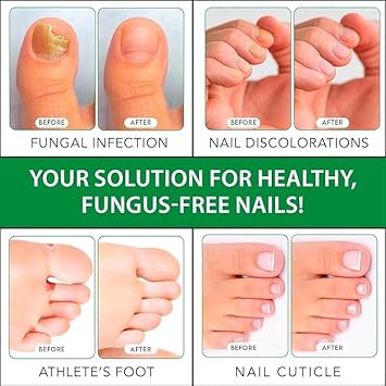 Viking Revolution Extra Strength Toenail Fungus Treatment with 1% Tolnaftate – Tea Tree Oil Nail Solution – OTC Antifungal