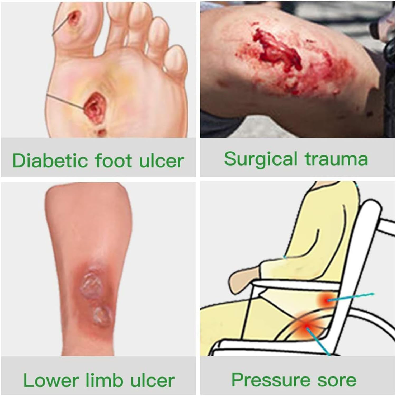 VED Dermapore Adhesive Wound Dressing- Suitable for cuts and grazes, Diabetic Leg ulcers, venous Leg ulcers, Small Pressure sores- Medium,9 X 15cm (Pack of 25). : Amazon.co.uk: Health & Personal Care