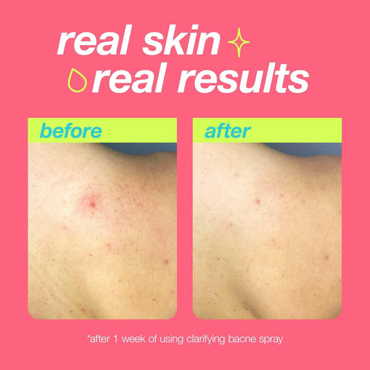 Dermalogica Clear Start Clarifying Bacne Spray, Back Acne Treatment Spray For Body Breakout - Pore Clearing, Preventing Pimple With Salicylic Acid, Witch Hazel, Tea Tree Oil, All Skin Type, 6 Fl Oz