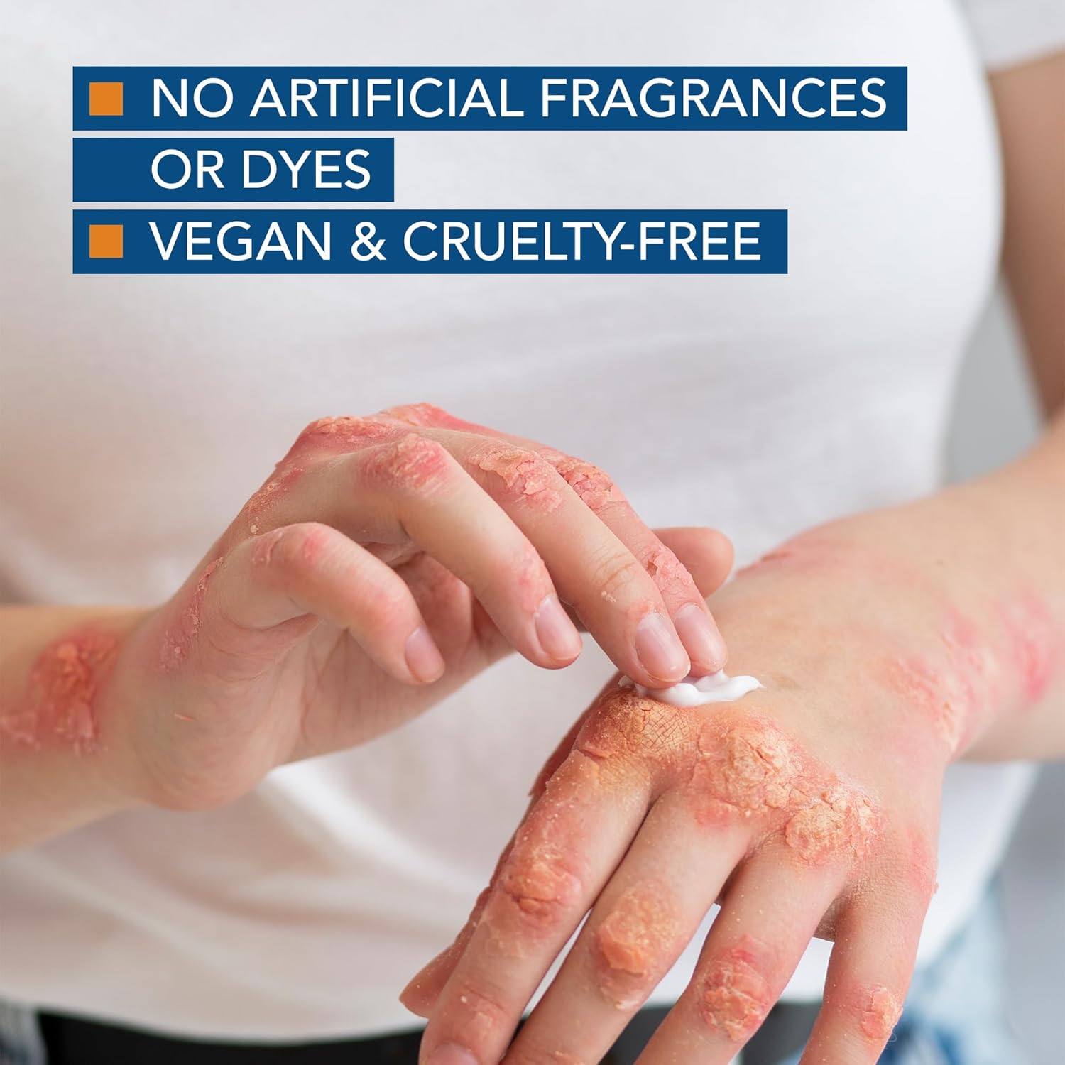 Kenkoderm Psoriasis Cream - Natural Moisturizing Face & Body Lotion With 2 Percent Salicylic Acid - Renewing Topical Formula For Dry & Sensitive Skin, Fragrance & Color Free, 10 Oz., 1 Jar : Health & Household