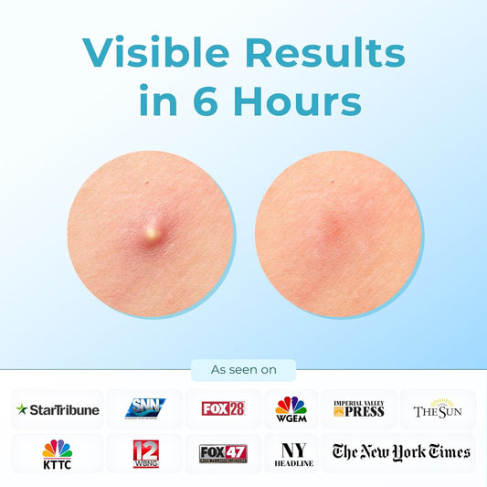 Hydrocolloid Pimple Patches (Made In Korea) Fsa/Hsa Eligible, Vegan, Hypoallergenic, Cruelty-Free | Acne Stickers, Overnight Treatment - For Zits, Spots, Pimples, Whiteheads (10 Count, Xl Patches)