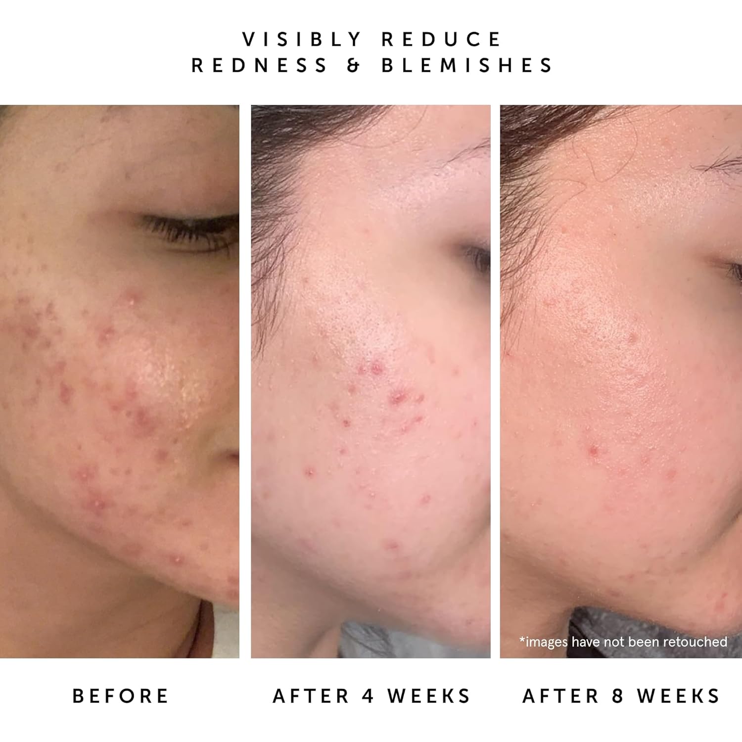 Herbivore Lapis Balancing Facial Oil With Blue Tansy + Squalane, Safe For Acne-Prone Skin | Helps Soothe Redness + Balance Oil Production, Lightweight, Non-Comedogenic, Plant-Based, 30 Ml / 1 Oz : Beauty & Personal Care