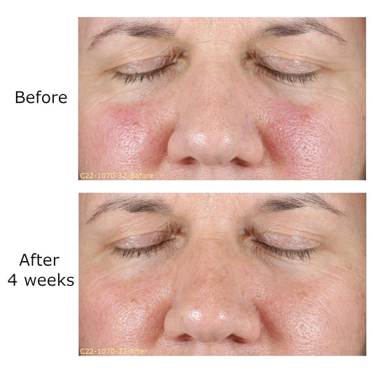 0.1% Retinol Cream: Ramp-Up Regimen 3 & Rhr Overnight Mask - Daily Face Moisturizer With Vitamin C, Bakuchiol, Rejuvenation (Activator Sold Separately)