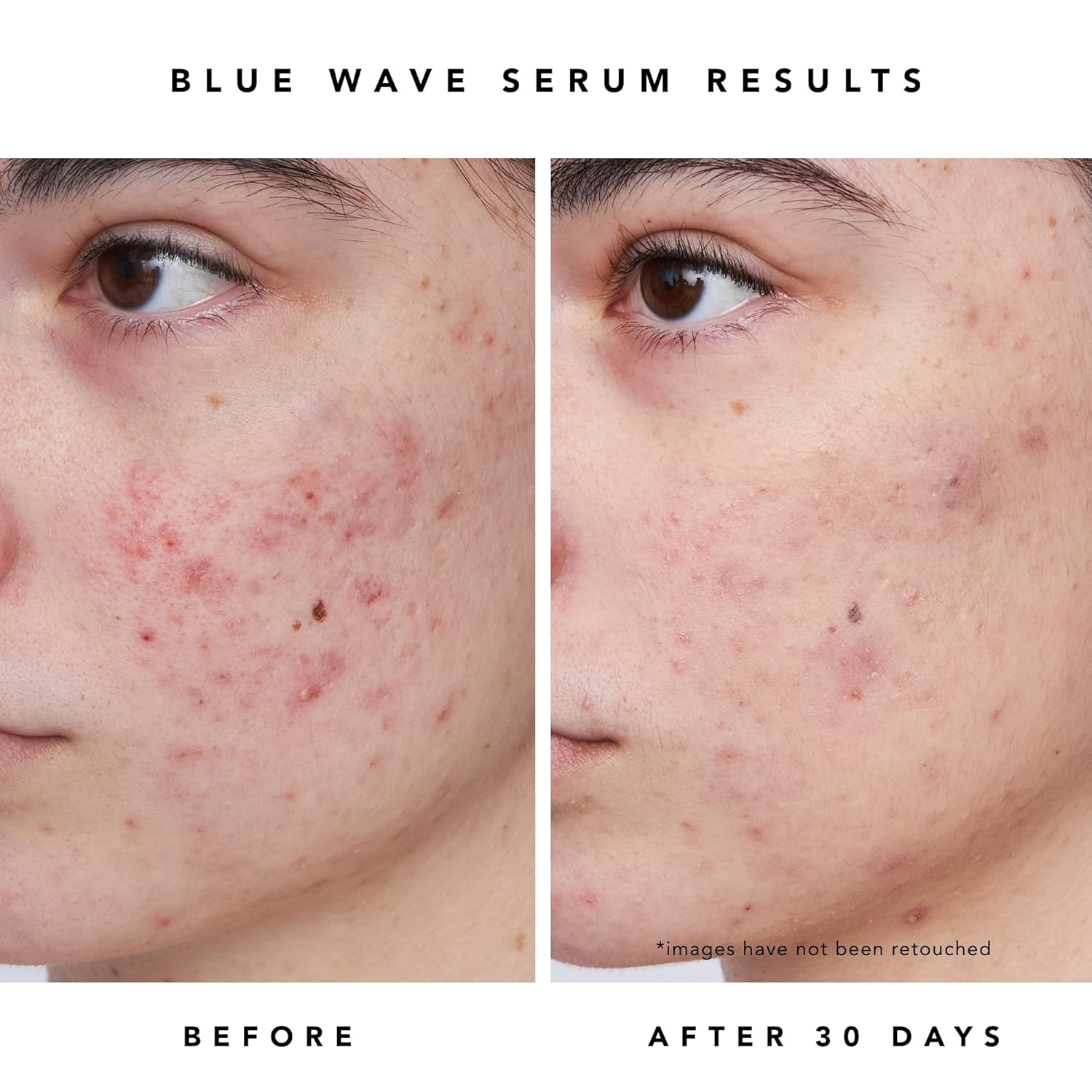 Herbivore Blue Besties Duo β 2-Step Treatment For Acne-Prone Skin, Aquarius Cleanser (50 Ml) & Blue Wave Serum (10 Ml), Plant-Based, Vegan, Cruelty-Free : Beauty & Personal Care