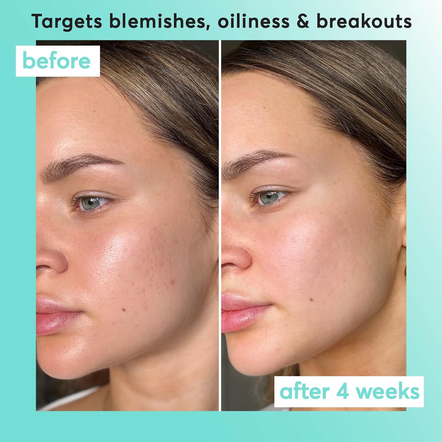 Super Facialist Breakout Buster Serum - Clear Skin Solutions, Spot Treatment for Acne with 10% Niacinamide, Tea Tree Oil & Prebiotics, Vegan Friendly 30ml : Amazon.co.uk: Beauty