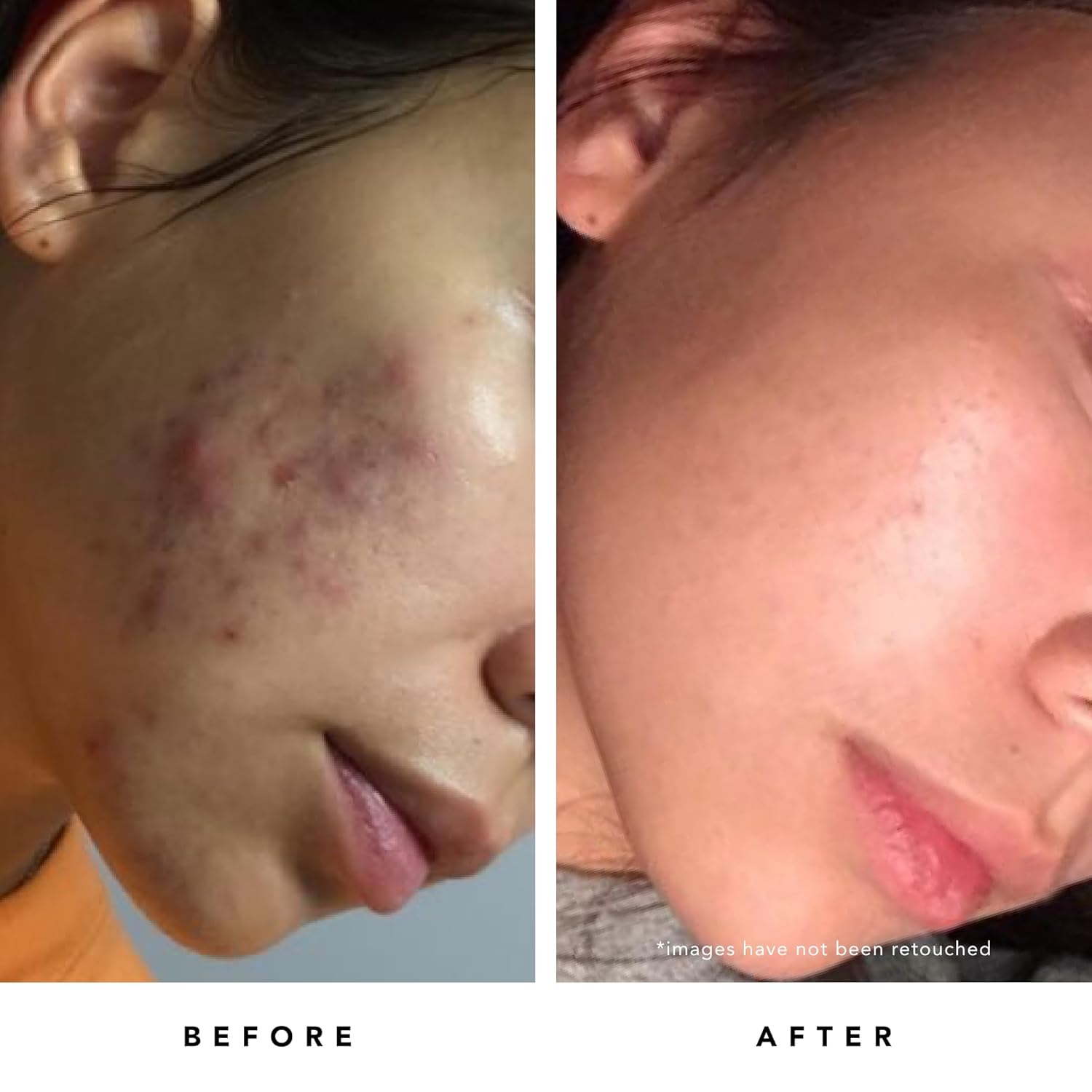 Herbivore Blue Tansy Resurfacing Clarity Mask | Bha + Fruit Enzymes Helps Clarify Acne + Blemishes And Reduce Appearance Of Pores | Vegan, Plant-Based, Cruelty-Free, 60 Ml / 2 Oz : Beauty & Personal Care