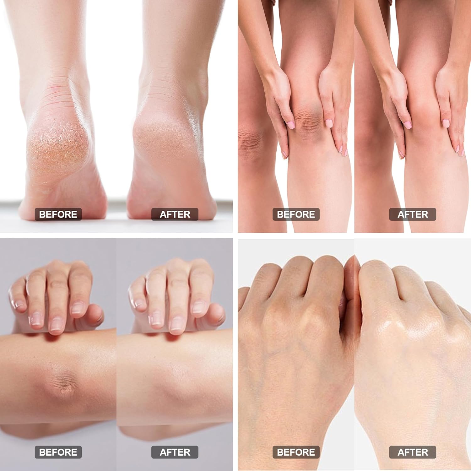 Urea Cream 40% - Foot Care For Dry Cracked Heels, Foot Lotion - With 2% Salicylic Acid, Tea Tree Oil, Shea Butter, Aloe Vera - For Feet, Hands, Heels, Elbows, Knees And More - 6 Oz : Beauty & Personal Care