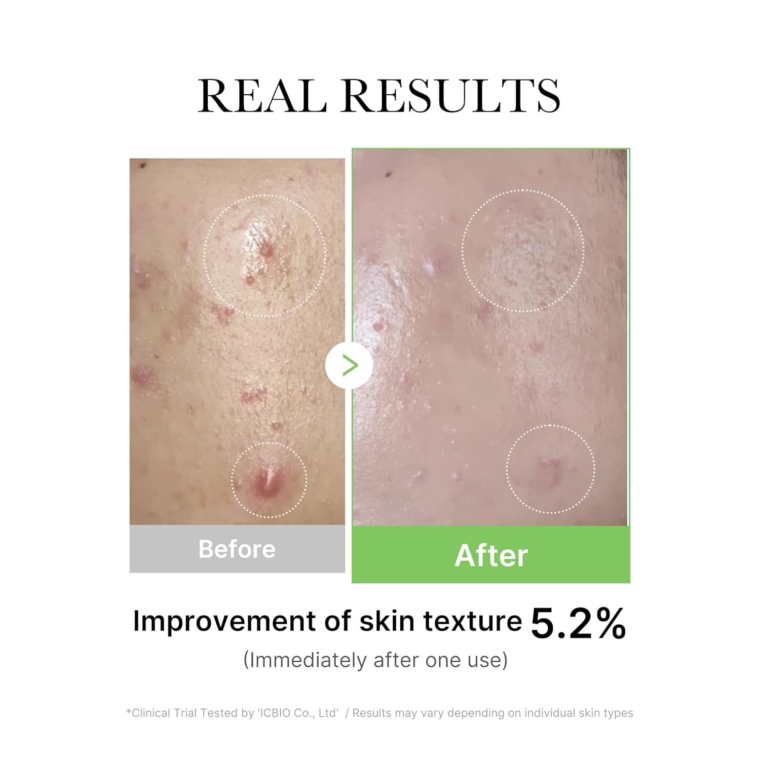 Medicube Exosome Cica Tea Tree Ampoule For Sensitive Skin With Centella Asiatica Help Reduce Redness And Breakouts. Low-Irritating, Moisturizing & Soothing Serum | Korean Skincare | 30Ml : Beauty & Personal Care