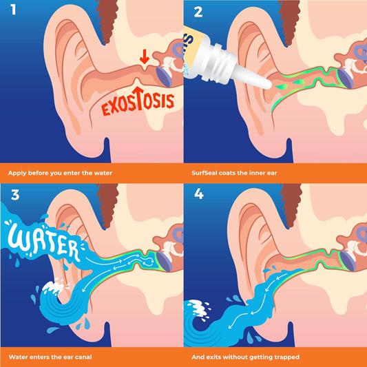 All Natural Swimmer'S Ear Drops For Daily Use Rather Than Alcohol Drops Or Earplugs. Avoids Earache & Blocked Ears From All Water Exposure For All Ages