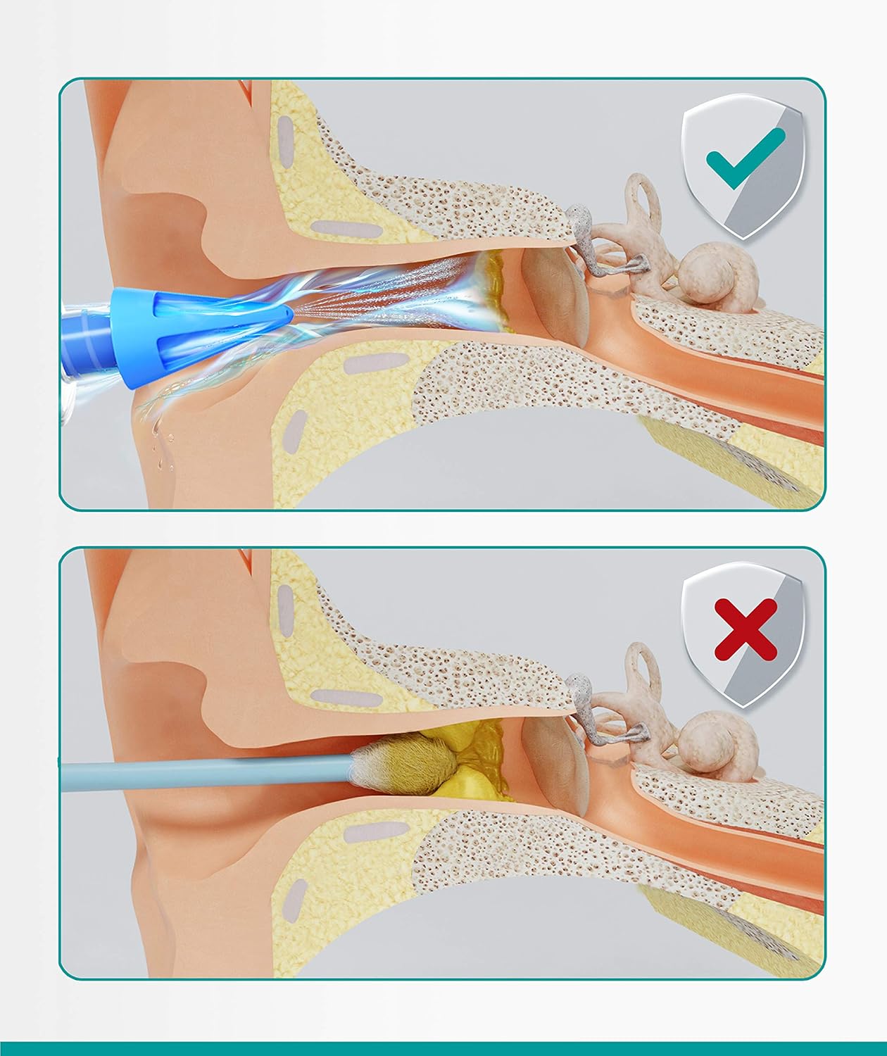 Medi Grade Ear Wax Removal Syringe - Natural Ear Cleaner for Safely Removing Ear Wax at Home - Reusable Ear Cleaning Kit with 3x Family Quad-Spray Safety Tips for Ear Irrigation - Ear Wax Removal Tool : Amazon.co.uk: Health & Personal Care