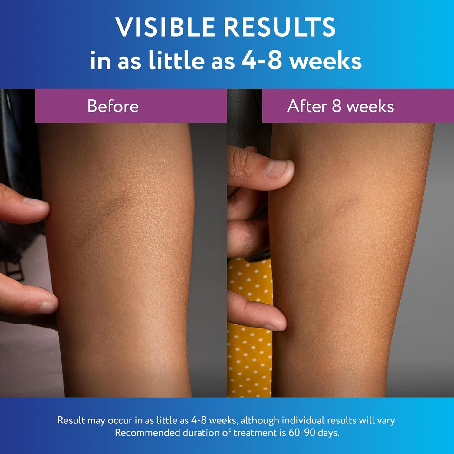 Scaraway Silicone Scar Gel, Helps Improve Size, Color & Texture Of Hypertrophic & Keloid Scars From Injury, Burns & Surgery, Water Resistant, 10G (0.35 Oz) : Health & Household