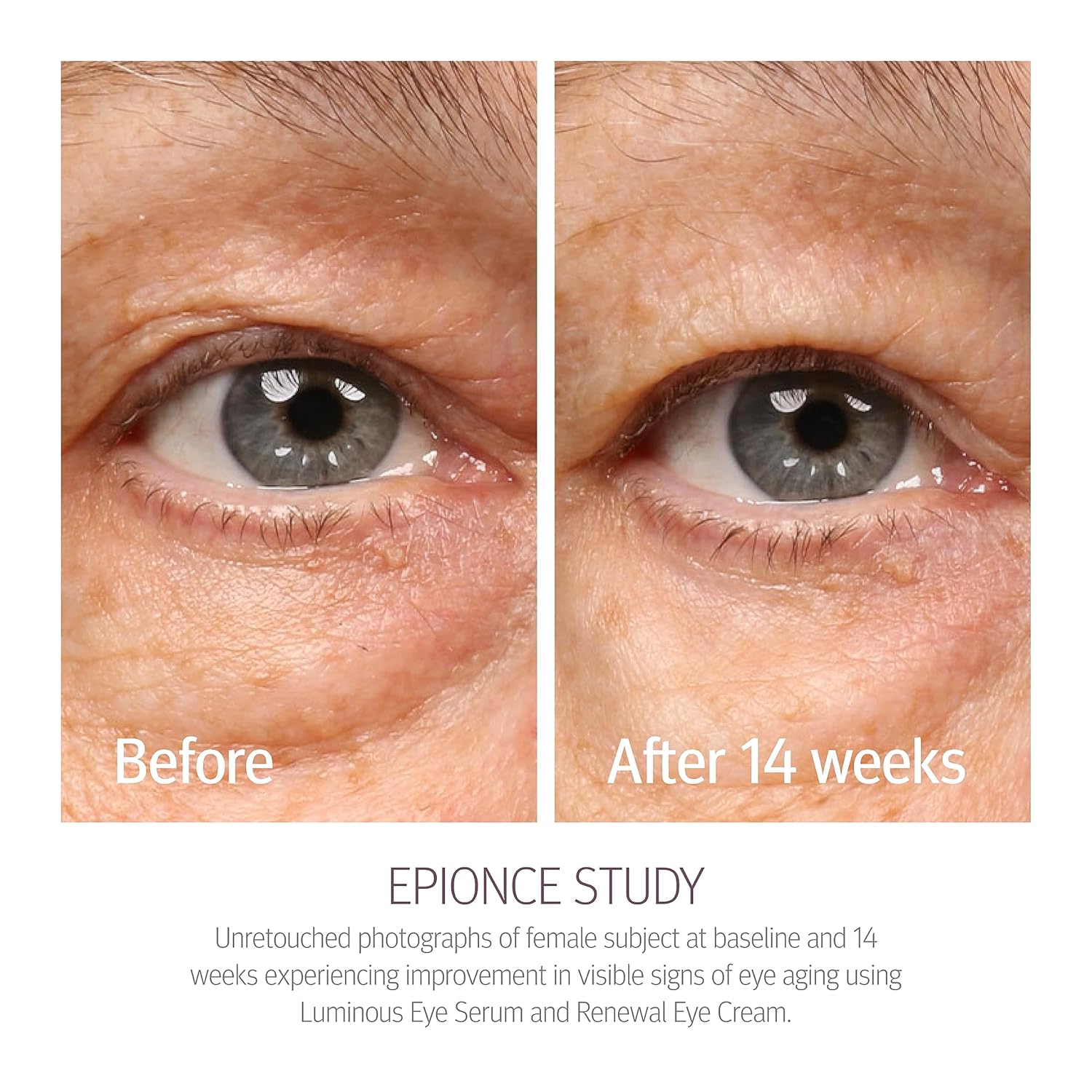 Epionce Renewal Eye Cream - Anti-Aging, Under Eye Cream For Dark Circles, Fine Lines, Wrinkles & Puffiness With Hyaluronic Acid, For All Skin Types, Dermatologist Skincare : Beauty & Personal Care