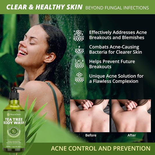 Tea Tree Oil Antifungal Soap – Antifungal Treatment For Face & Body Acne, Athlete'S Foot, Tinea, Folliculitis Ringworm Jock Itch - Refresh & Cleanse With Natural Herbal Extracts