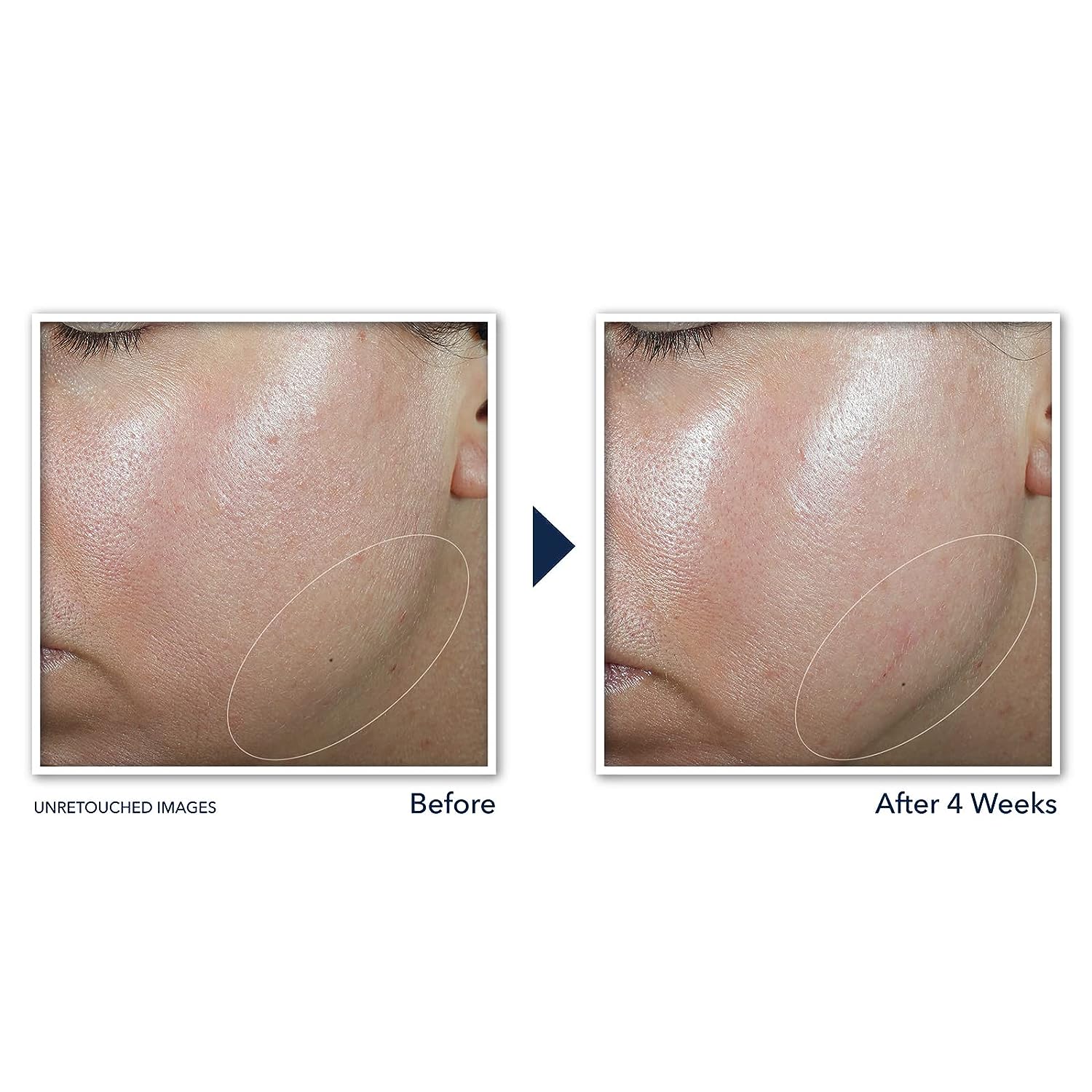 Esupli.com RoC Derm Correxion Neck Cream with Hyaluronic Acid and Advan