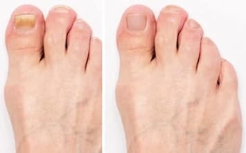 ClearZal Complete Fungal Nail Treatment | Foot and Nail System | Kills fungus, bacteria and viruses : Amazon.co.uk: Health & Personal Care