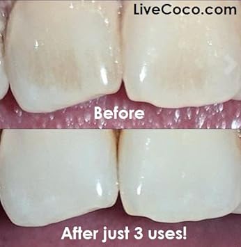 Activated Charcoal for Teeth Whitening, Natural Teeth Whitening using Coconut Shells, RAW & Food Grade with No Artificial Flavours, 100% Natural, Large Tub, 80g=300 Uses from LiveCoco : Amazon.co.uk: Health & Personal Care