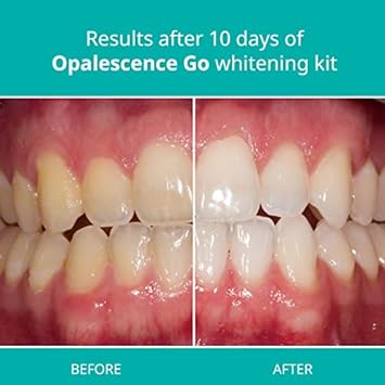 Opalescence Whitening Bundle - Opalescence Go 10% Hydrogen Peroxide Prefilled Whitening Trays and Whitening Toothpaste - Mint Flavor 5194-5166