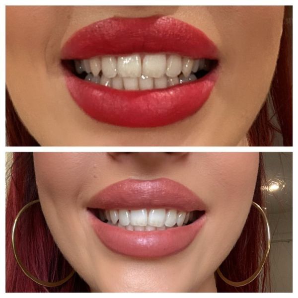 Smiletime Pap Teeth Whitening Pen