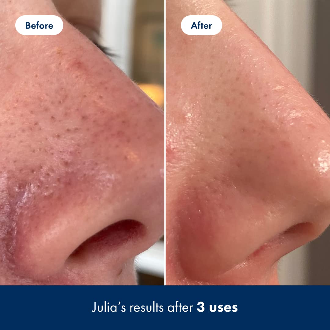 Hero Cosmetics Pore Release Blackhead Clearing Solution - Exfoliating Toner Featuring Bha, Pha, Aha And 2% Salicylic Acid (100 Ml) : Beauty & Personal Care