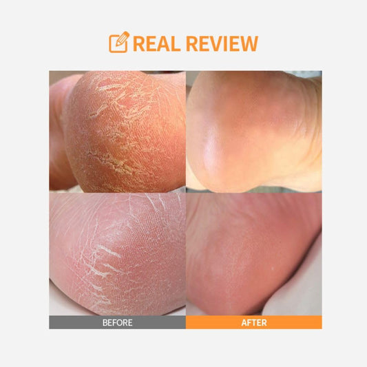 Sungboon Editor Lha Baby Foot Scrub Stick, Exfoliant Foot, Lha Chemical Peeling With No Peel-Off Remover, No Peeling-Off Foot Mask, Make Baby Feet, Remove Dead Skin Gently, Korean Skincare