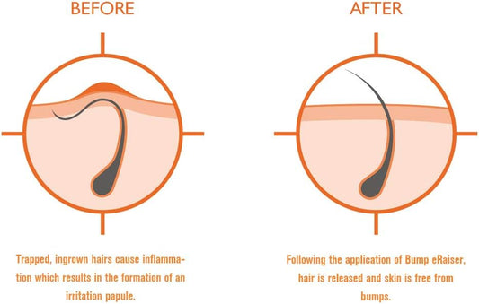 Bump Eraiser Triple Action Lotion 3 In 1 For Shaving Rash, Ingrown Hair Treatment, Razor Bumps And Razor Burns