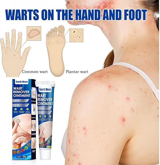 Wart Remover Treatment Blemish Ointment- wart remover for hands face body Skin Tag Removal Skin Corrector Removal Cream (20g)