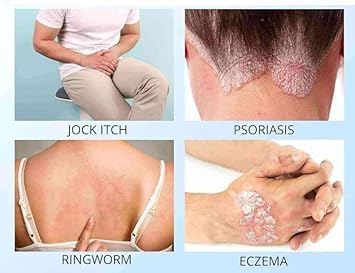 Effective 2% Anti Fungal Soap | Treats Intensive Fungal Infections Of The Skin | Ringworm, Jock Itch, Dry Skin, Dandruff, Acne | 75G
