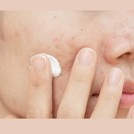 M.A.D Skincare Breakout Control Daily Moisturizer - For Acne Prone Skin 1.7 Oz