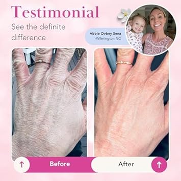 Theraplex Clear Emollient Lotion (8 Oz) - No Parabens Or Preservatives, Noncomedogenic And Hypoallergenic, Fragrance Free, Dermatologist Recommended - National Eczema Association Seal Of Acceptance : Body Lotions : Beauty & Personal Care