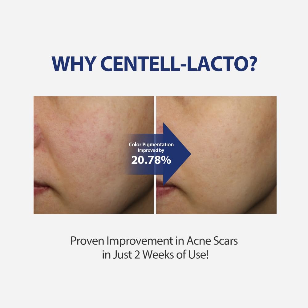 Sungboon Editor Centell Lacto Ac Less Skin Barrier Essence Serum | Acne Treatment For Face | Probiotics Skin Care For Sensitive Skin | Niacinamide Hydrating Face Serum | Korean Skin Care