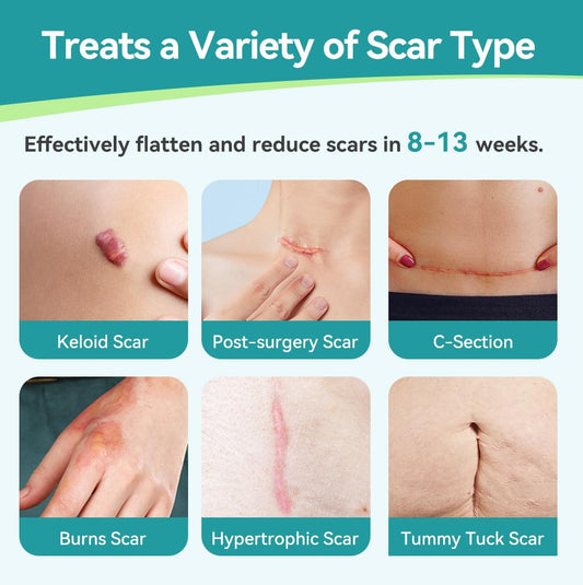 Dimora Waterproof Silicone Scar Sheets - Medical Grade Hypoallergenic Silicone Scar Tape (1.6”X60" Roll), Ultra-Soft Scar Removal Treatment For Surgical Scars, C Section, Tummy Tuck, Keloid Treatment