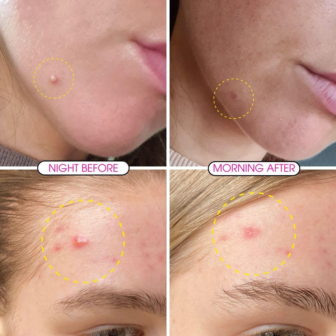 Clear Skin Days Blemish Treatment Cream - Overnight Spot & Acne Treatment for Face - with Salicylic Acid & Zinc - Calm Aggravated Skin, Treat Blemishes & Acne 30ml