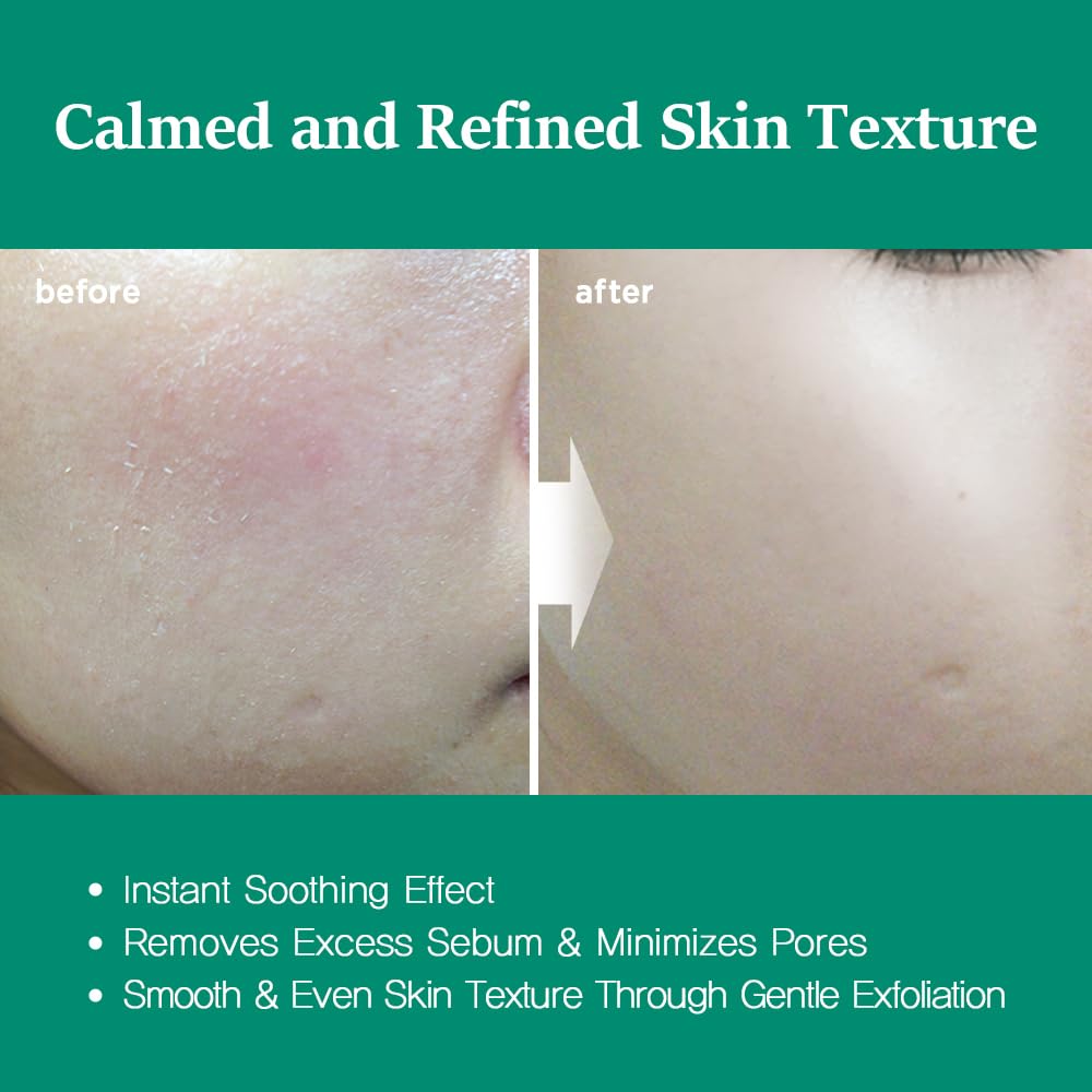 Nightingale Teatree Calming Pads, Facial Toner Pads With Tea Tree & Pha, Low Ph Daily Toner Pads, Soothing For Sensitive & Irritated Skin, Hypoallergenic, Vegan Pads, Korean Skin Care : Beauty & Personal Care