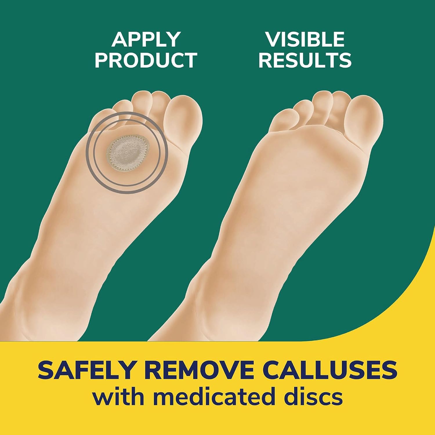 Dr. Scholl'S Extra Thick Callus Remover, 4Ct // Helps Soften Hard Calluses And Cushions For All-Day Pain Relief : Health & Household