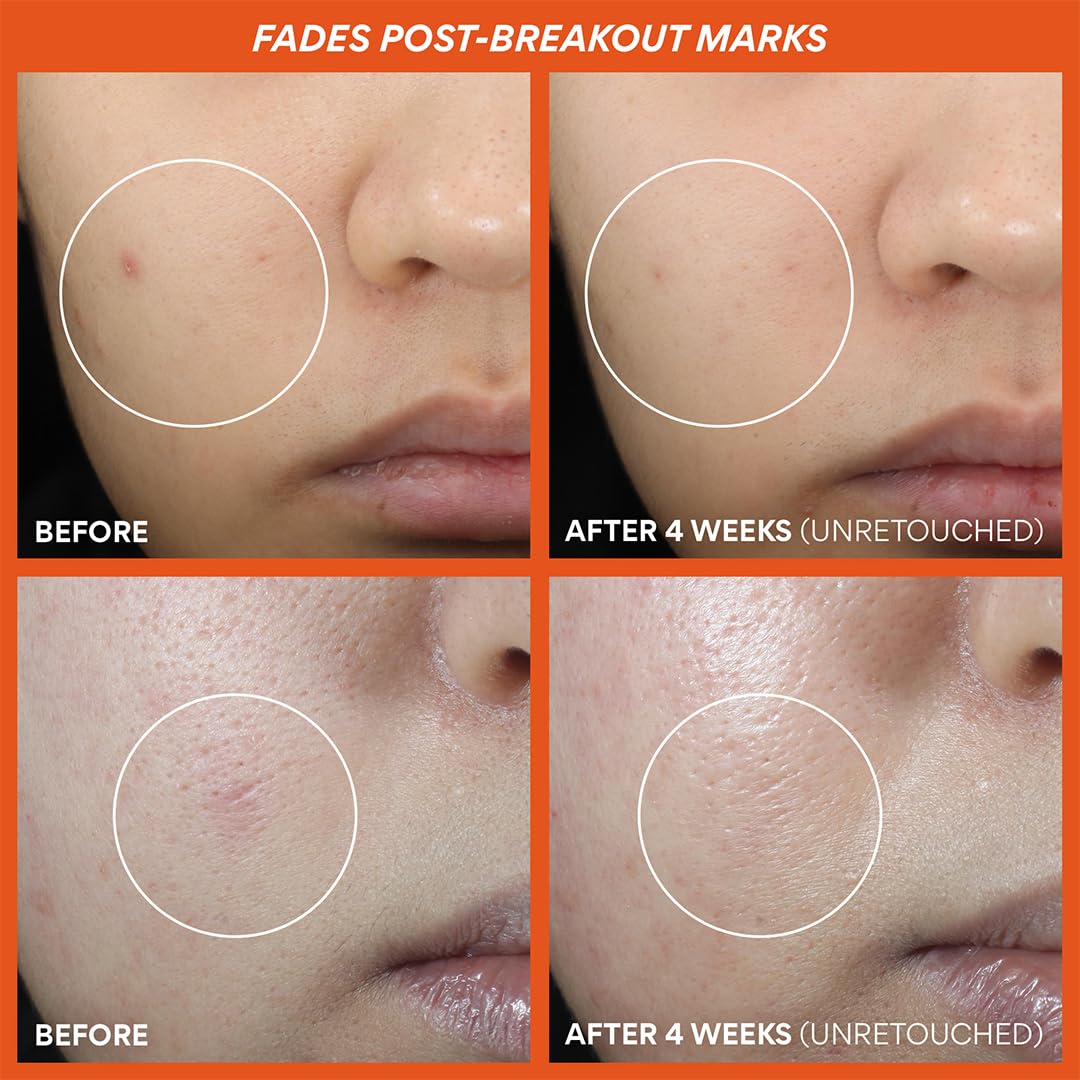 Innisfree Green Tea Enzyme Vitamin C Toner Pads, Korean Brightening Face Pads For Dark Spots, Radiance, And Even Skin Tone : Beauty & Personal Care