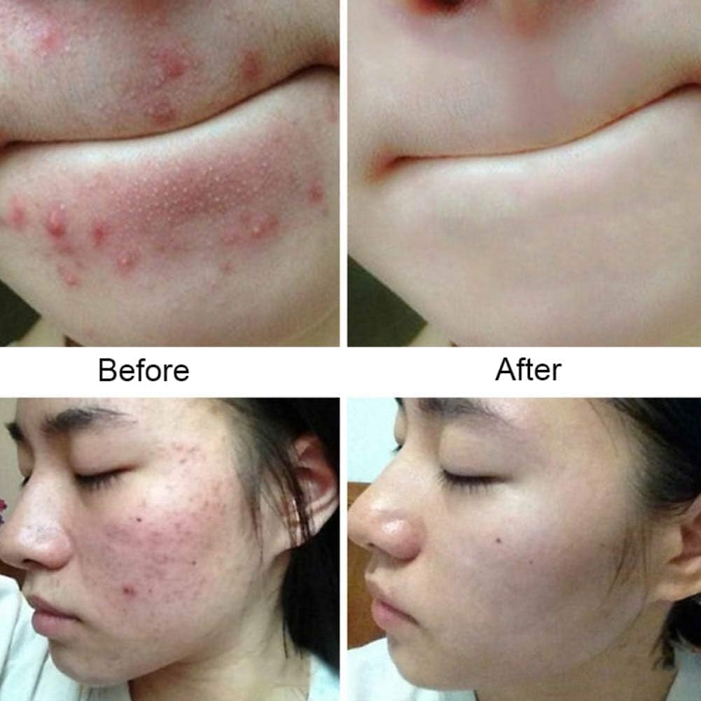 Anti Fungal & Anti Bacterial Soap 2% Ketoconazole For Intensive Fungal Infections Of The Skin | Helps Wash Away Ringworm, Jock Itch, Dry Skin, Dandruff, Acne | 75G