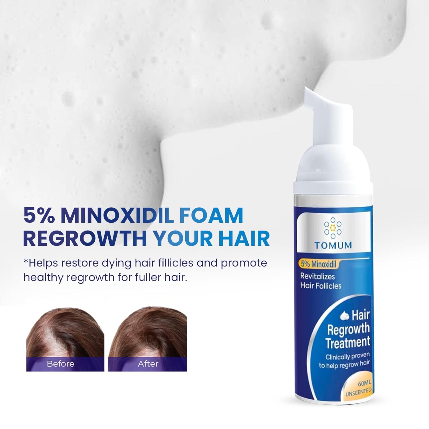 5% Minoxidil Foam for Men and Women Topical Hair Loss treatments Hair Growth Serum- Slows Hair Loss & Promotes Regrowth For Thicker, Longer Hair 2 Month Supply : Beauty & Personal Care