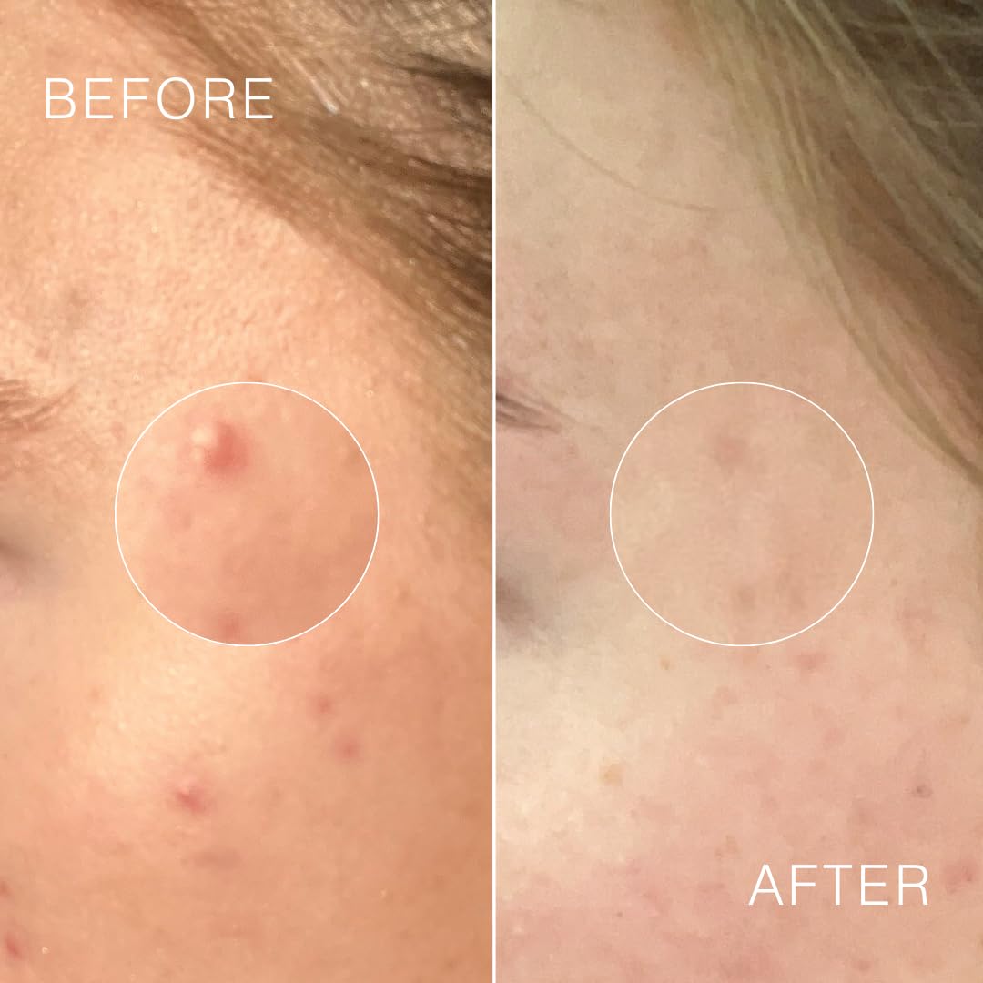 Dr Sebagh Complete Breakout Solution For Oily Skin - 1 X Balancing Cream (1.7 Fl Oz.) & 5 X Spot Treatment Powders (0.07 Oz.) | Award-Winning | Rapid & Effective Results For Blemish-Prone Or Oily Skin : Beauty & Personal Care