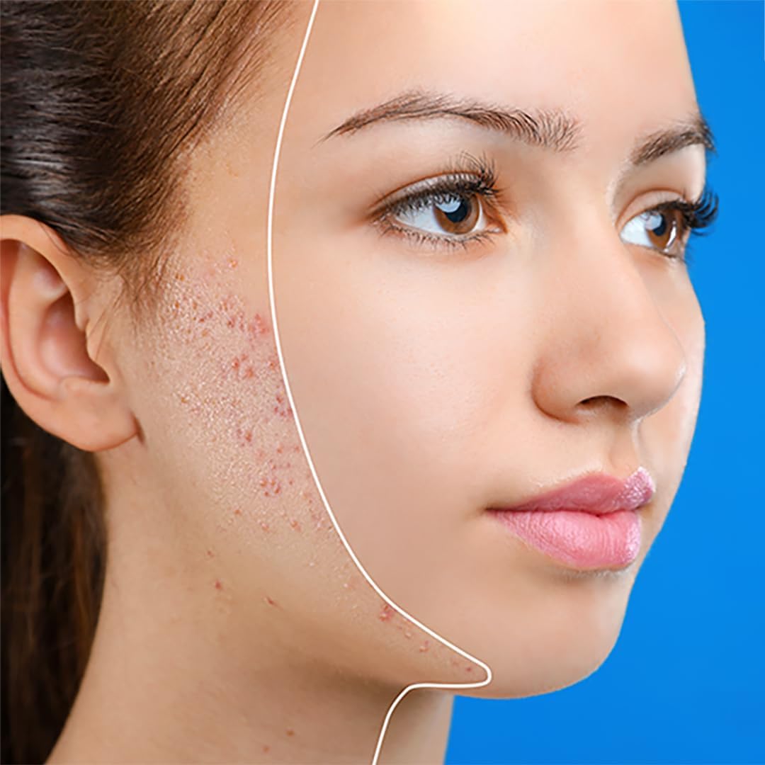 Silicolskin - For Spots, Blackheads, And Oily Skin - A Clinically Tested Solution - 50Ml