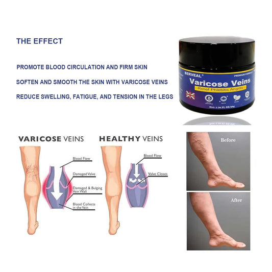 Varicose Veins Cream, Spider Veins Repair Cream, Improve Blood Circulation, Spider Varicose Vein Treatment Cream For Legs, Itching Of Legs (1.76 Oz) (1)
