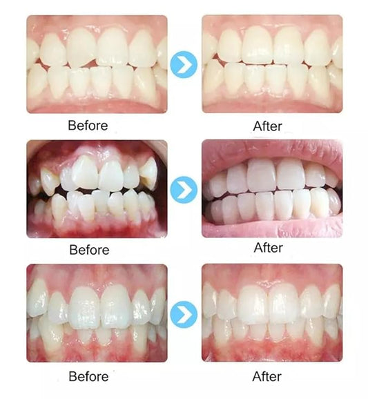 Whitening Mouthpieces-Children's Dental Appliances: Orthodontic Braces, Alignment Trainers, and Whitening Mouthpieces for Straightening Teeth