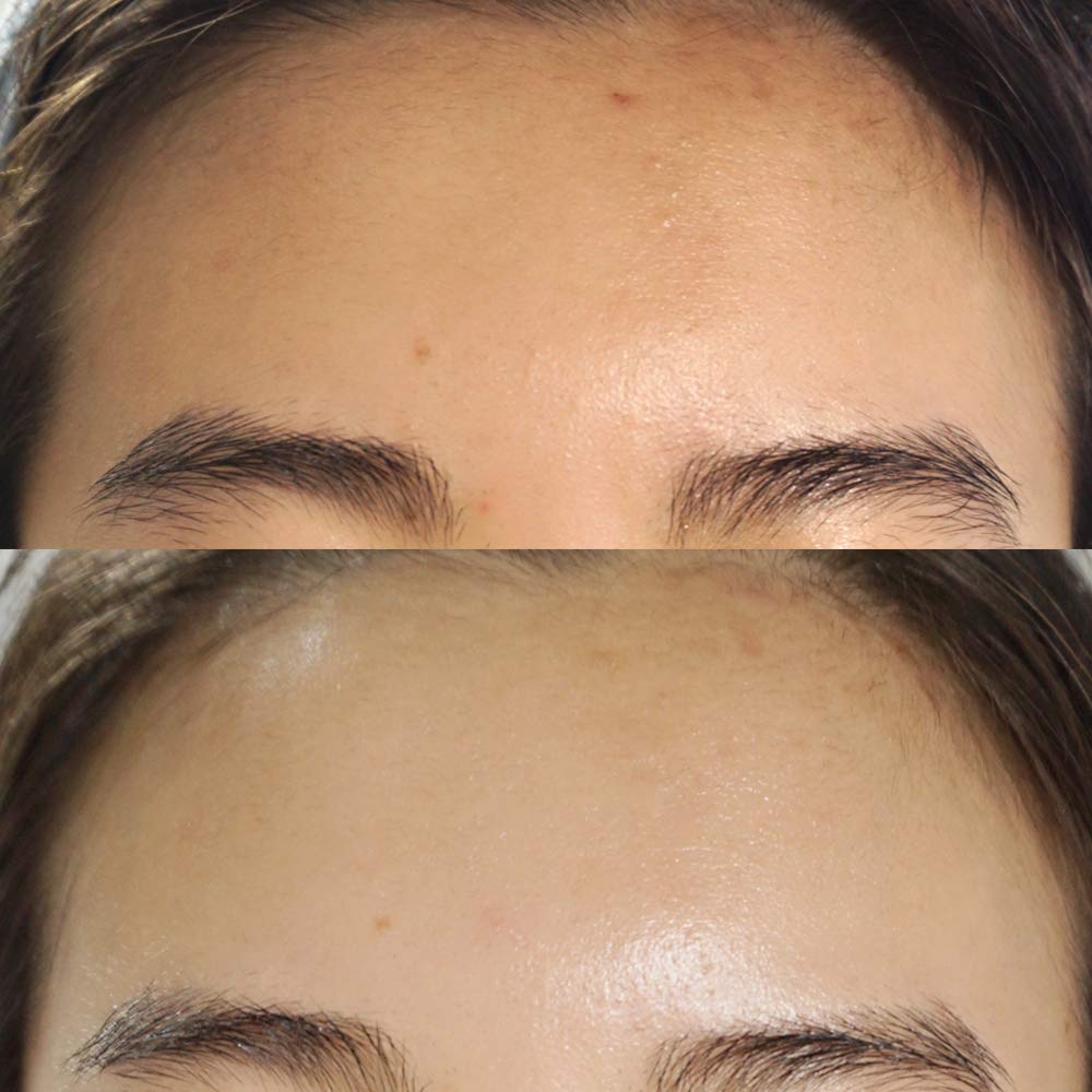 Bonajour] Extreme Acne Blemish Repair&Soothing Cream - Intensive Care For Acne And Skin Barrier Cream 1.75 Fl.Oz : Beauty & Personal Care