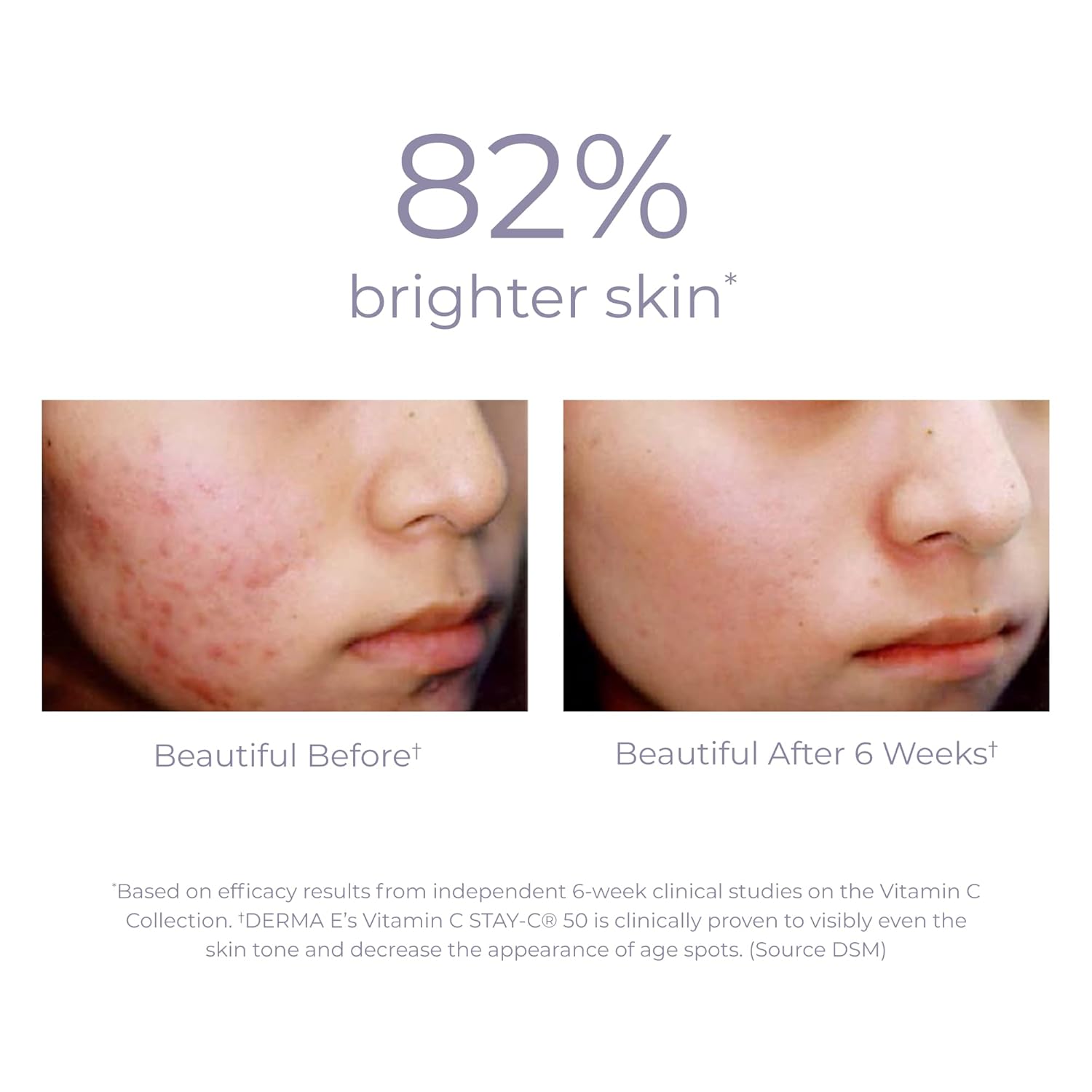 DERMA E Vitamin C 10% Multi-Acid Radiance Liquid Peel – Exfoliating and Brightening Skin Care Treatment with Niacinamide, Lactic Acid and Bromelain – For Uneven Tone and Discoloration, 1 Fl Oz : Beauty & Personal Care