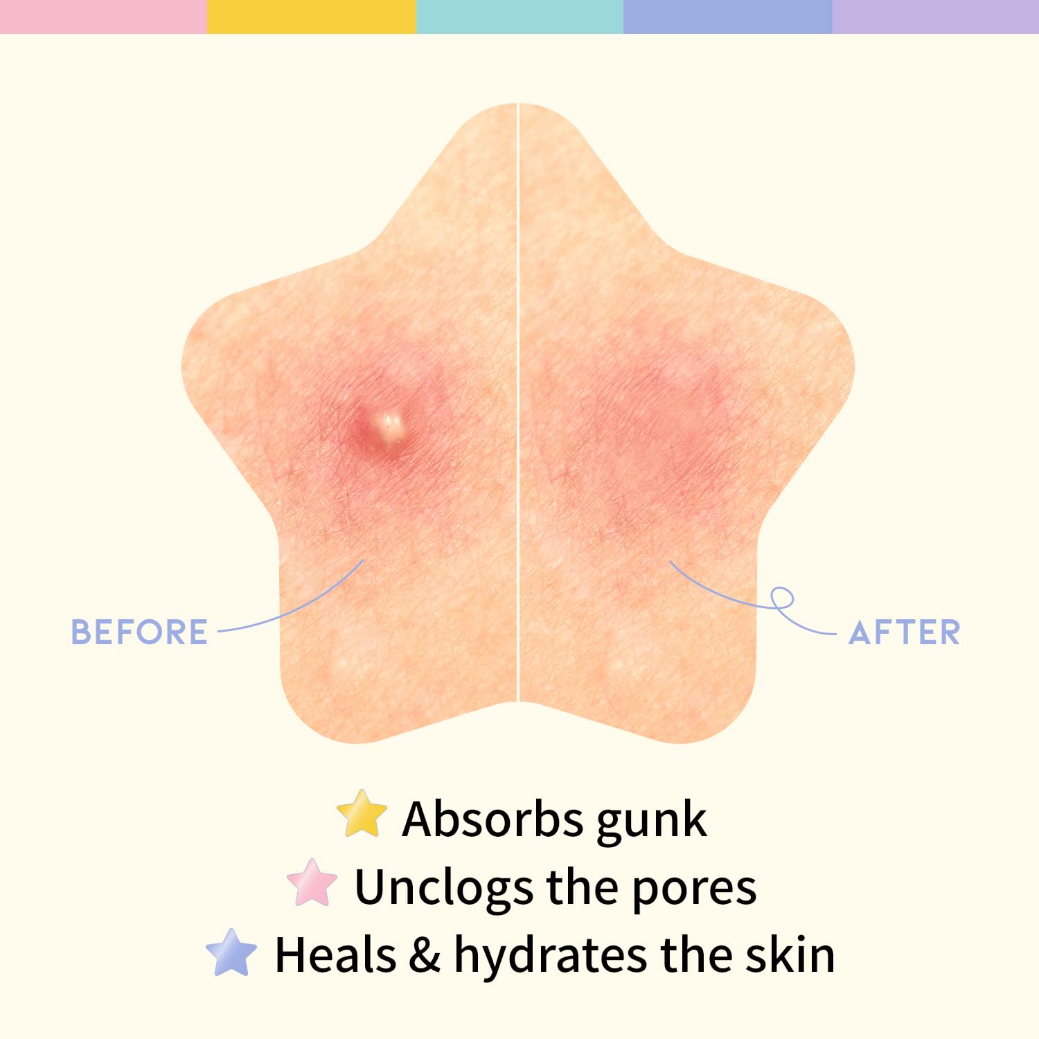 Star Spot Acne/Pimple Patch For Face, Hydrocolloid, Niacinamide, Ceramide, Cute Pastel Colors, Protecting & Healing, Prevent Scarring, Blemish Remover, Ideal For Blemish Spots, Made In Korea 80 Counts