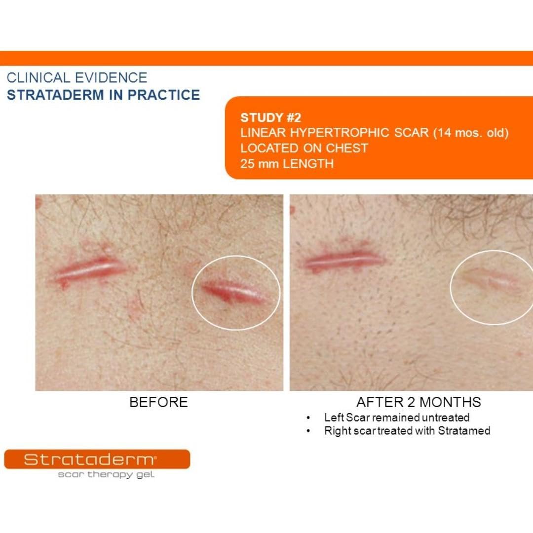 Strataderm Scar Therapy Gel 5G : Scar Reducing Treatments : Health & Household