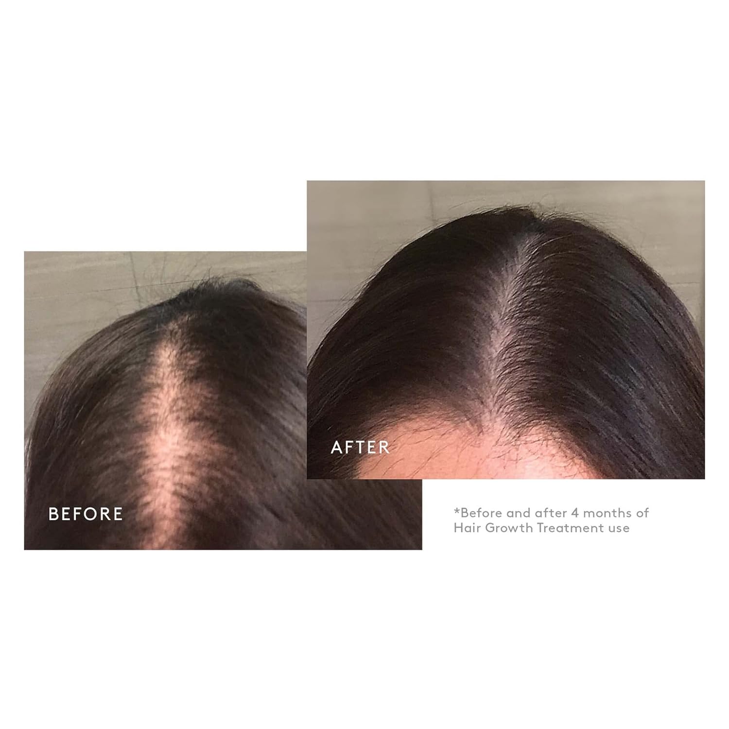 Virtue Flourish Hair Growth Regimen with Minoxidil 5% Foam : Beauty & Personal Care