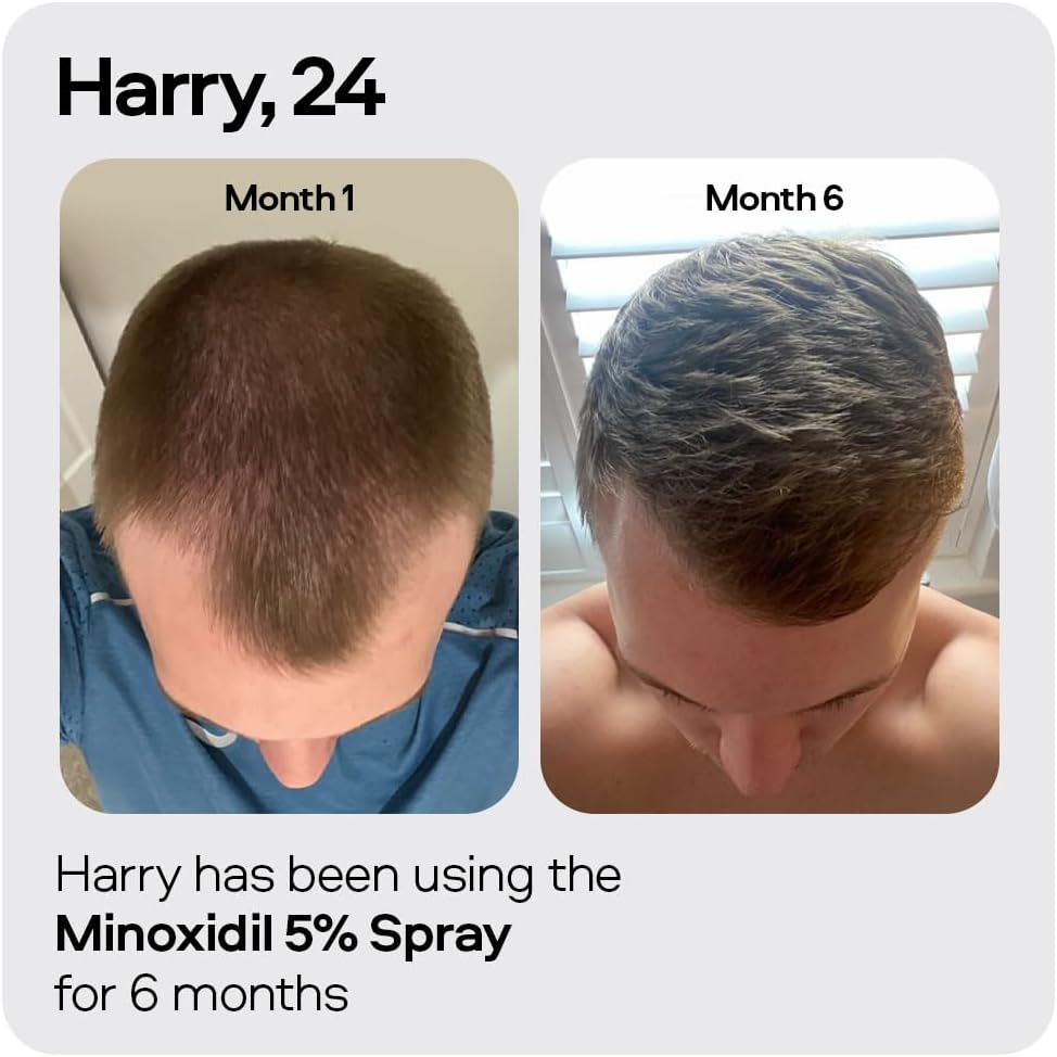 Sons Minoxidil 5% Cutaneous Solution for Men, Hair Regrowth & Thickener Formula, For Hair Loss & Thinning, Reactivates Shrunken Follicles, Precision Application System, 3 Month Supply Made in Europe : Amazon.co.uk: Beauty