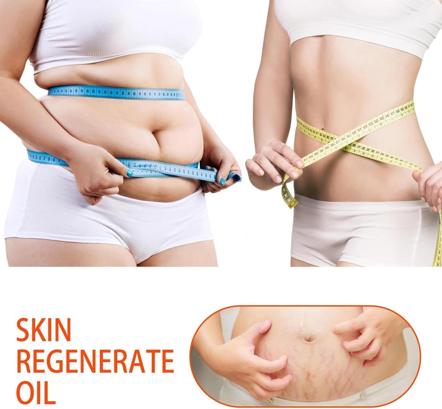 Stretch-Marks, Scar Treatment Oil - Boosts Collagen For Skin Lifting - Improves Treat Of Scars, Stretch-Marks & Uneven Skin Tone - 125Ml
